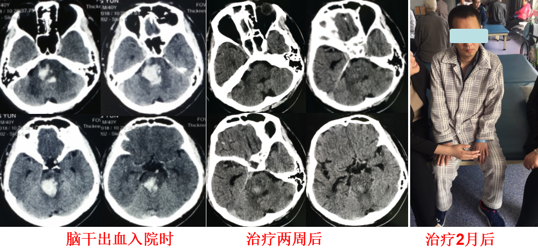 脑干出血来势凶猛,其实也没那么可怕