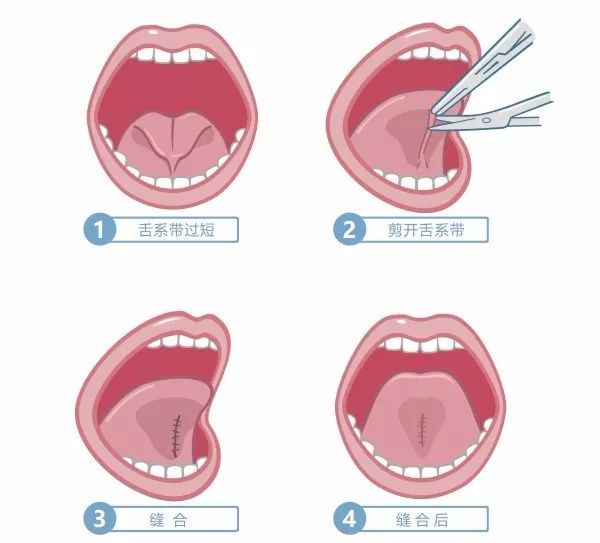 “舌系带问题”越早手术越好！康华医院成功实施小儿舌系带